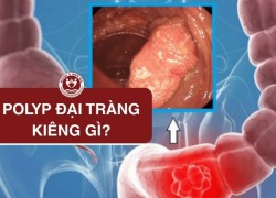 7 Nhóm Thực phẩm Người Bị Polyp Đại Tràng Nên Tránh Xa